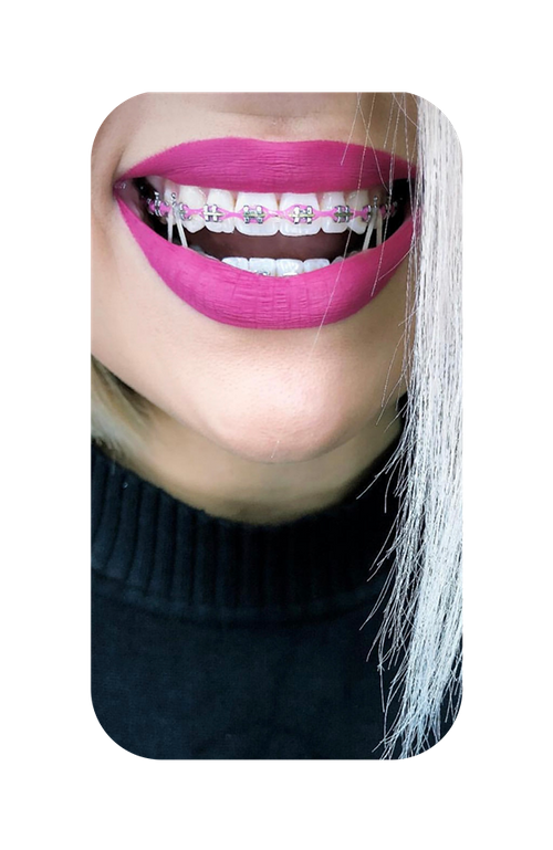 A happy smile with color braces.